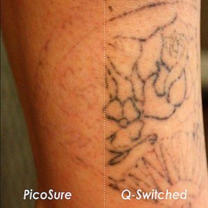 Eliminar tatuaje con láser Picosure, antes y después