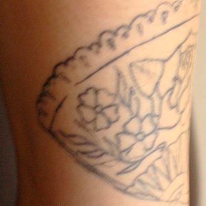 Eliminar tatuaje con láser Picosure, antes y después