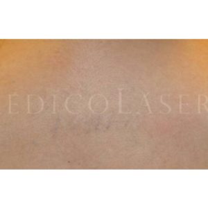 Pre y post eliminar tatuajes. Resultados
