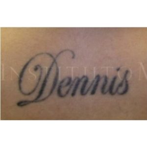 Pre y post eliminar tatuajes. Resultados
