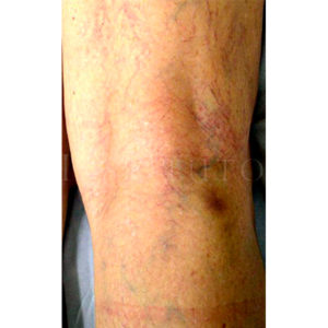 Eliminar varices telangiectasias con láser, imágenes del resultado