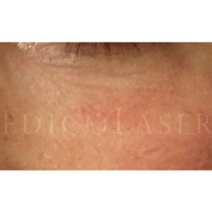 Eliminar grasa bajo los ojos con Blefaroláser, antes y después