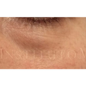 Eliminar grasa bajo los ojos con Blefaroláser, antes y después