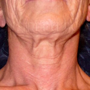 Antes y después del lifting facial en IML