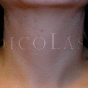 Eliminar manchas en el cuello, fotos de antes y después