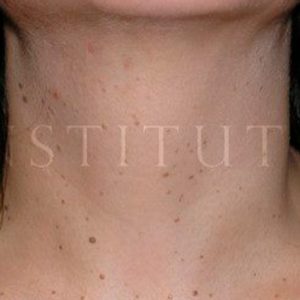 Eliminar manchas en el cuello, fotos de antes y después