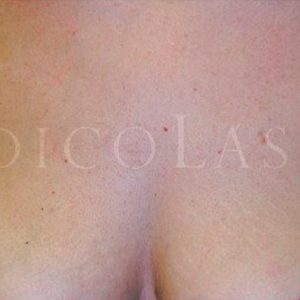 Eliminar manchas en el escote, antes y después