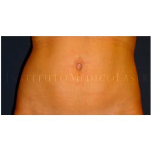 Flacidez abdominal, resultados pre y post Renuvion