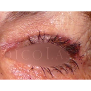 Blefaroplastia superior, antes y después