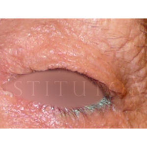 Blefaroplastia superior, antes y después