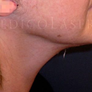 Fotos pre y post lifting cervical