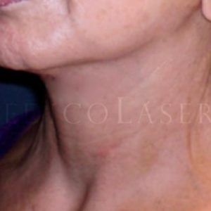 Fotos de resultados pre y post Lifting facial