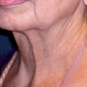 Fotos de resultados pre y post Lifting facial
