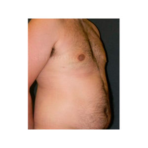 Ginecomastia. Liposucción (Antes y después)