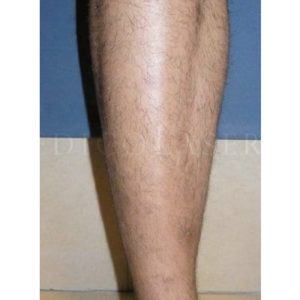 Hiperpigmentaciones en piernas: antes y después