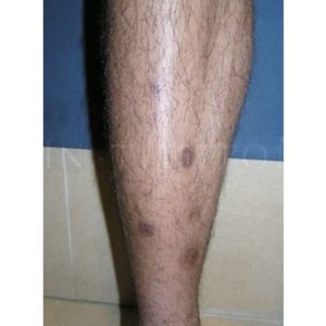 Hiperpigmentaciones en piernas: antes y después