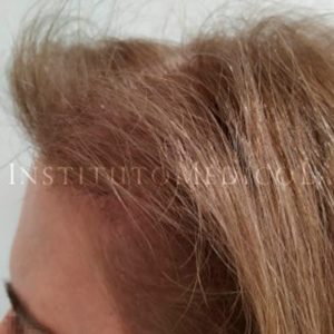 Injerto capilar en mujeres, antes y después