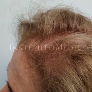 Injerto capilar en mujeres, antes y después