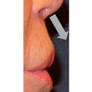 Antes y después de corregir el labio caído