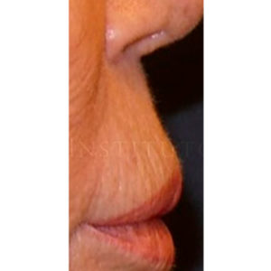 Antes y después de corregir el labio caído