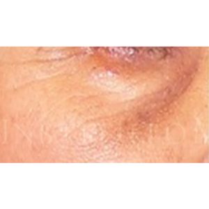 Ojeras pigmentarias, antes y después