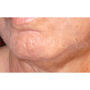 Láser para rejuvenecimiento facial, antes y después