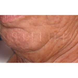 Láser para rejuvenecimiento facial, antes y después
