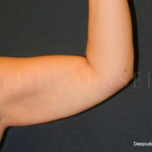 Lipoláser en brazos. Foto de antes y después