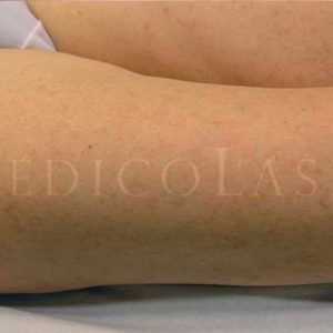 Léntigos en las piernas, antes y después