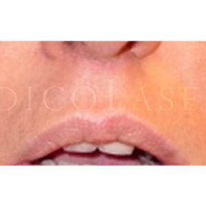 Levantar el labio superior con Lip Lift, resultados
