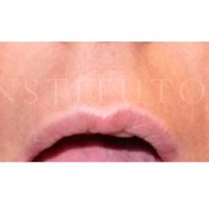 Levantar el labio superior con Lip Lift, resultados