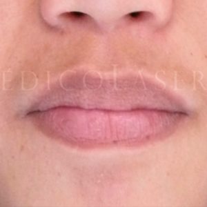Levantar el labio superior, antes y después