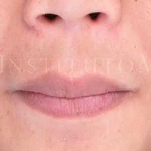 Levantar el labio superior, antes y después
