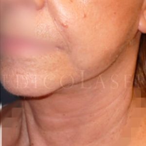 Antes y después del lifting para arrugas en cara y cuello