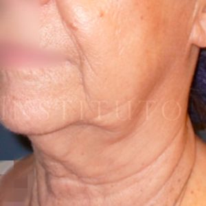 Antes y después del lifting para arrugas en cara y cuello