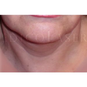 Antes y después de eliminar arrugas en el cuello