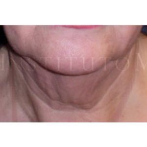 Antes y después de eliminar arrugas en el cuello