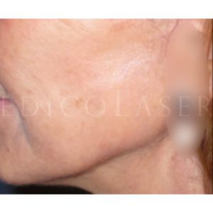 Antes y después del lifting: borde mandibular
