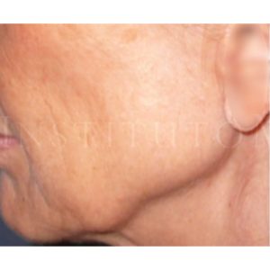 Antes y después del lifting: borde mandibular