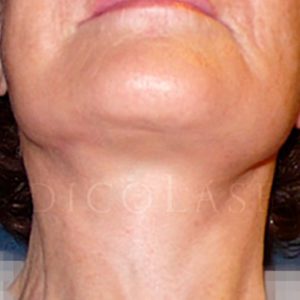 Antes y después del lifting: casos reales