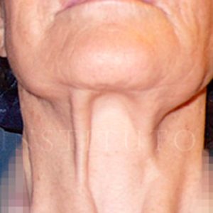 Antes y después del lifting: casos reales