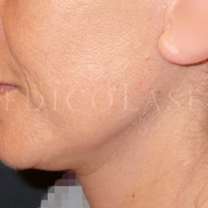 Antes y después del lifting cérvico-facial