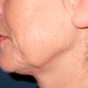 Antes y después del lifting cérvico-facial