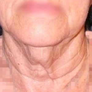 Antes y después del lifting en cuello