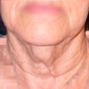 Antes y después del lifting en cuello