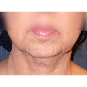 Antes y después del lifting para cara y papada