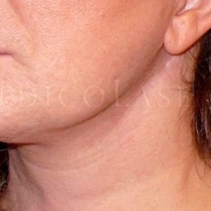 Antes y después del Lifting en cuello con técnicas no invasivas