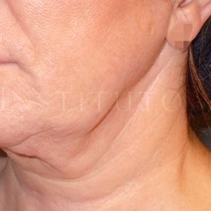 Antes y después del Lifting en cuello con técnicas no invasivas