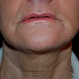 Lifting de cuello sin cirugía, antes y después