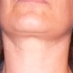 Antes y después del lifting platisma